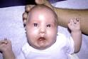 Picture 1 - <b>Moebius Syndrome</b>