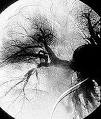 of <b>Takayasu's arteritis</b> is
