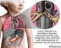 Cystic <b>fibrosis</b> | UF Health, University of Florida Health