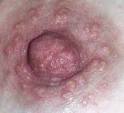 <b>Enfermedad</b> de <b>Paget</b> ← Volver