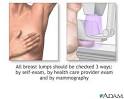 Breast lumps