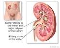 How To Cure Kidney Stones At Home Naturally ???? | PRLog
