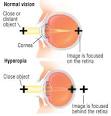 Farsightedness (Hyperopia) Guide: Causes, Symptoms and Treatment ...