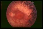 <b>Retinitis Pigmentosa</b>