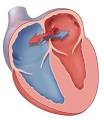 Congenital <b>Heart</b> Disease