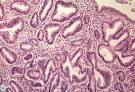 <b>Hiperplasia endometrial</b> simple.
