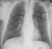 solitary <b>pulmonary</b> nodule