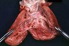 <b>Endocardial fibroelastosis</b>: