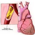 <b>Arteriosclerosis</b> can be