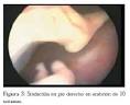 de <b>aborto retenido</b> permite