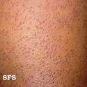 Keratosis pilaris, chicken