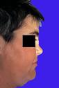 <b>granulomatosi di Wegener</b>.