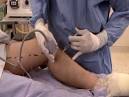 YouTube - Endovenous laser treatment - YouTube