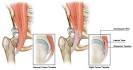 Hip Arthroscopy - Hip Anatomy &amp; Hip Pain Causes, New York