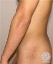 <b>Dermatite herpetiforme</b> de