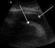 Cardiac tamponade - Wikipedia, the free encyclopedia