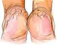Home Remedies for Cracked Heels. Dry Feet – Causes, Treatment ...