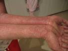 File:<b>Eczema</b>-arms.jpg