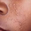 Clinical Information | CDC Molluscum Contagiosum