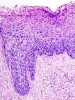 File:Cervical intraepithelial neoplasia (4) CIN3.jpg - Wikipedia ...