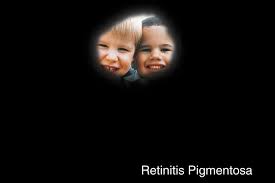 Qvision RETINOSIS PIGMENTOSA: Los ácidos grasos omega-3 multiplican el efecto protector de la vitamina A images?q=tbn:ANd9GcSF3ZA2GrbGODGooduR3HnE4Br5sQhLakrtMpkjyw E4a6YivC6