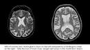 Physiology and Neuroanatomy of Huntington's Disease