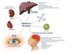disease (<b>hepatolenticular</b>