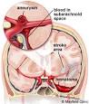<b>Subarachnoid hemorrhage</b> (