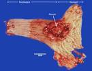 Johns Hopkins Barrett's Esophagus and ESOPHAGEAL CANCER Web ...