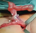 Mixed <b>gonadal dysgenesis</b>