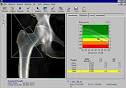 Services-Procedures-Bone Density Test