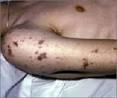 Blood Infection Symptoms Causes Suggestions | Blood Infection ...