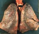 <b>Pulmonary Fibrosis</b>