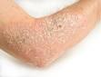 <b>Eczema</b> / Psoriasis