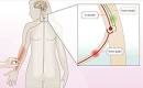 Opioids and Opioid-Induced Constipation (