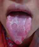 <b>Tongue</b>