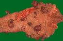 <b>adenomatous polyposis coli</b>