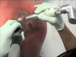 Laser Ink Removal For Tattoos