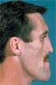 <b>Acromegaly</b>.