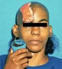 Delusional disorders in dermatology: a brief review