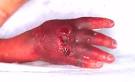 The management of extravasation injury in neonates.