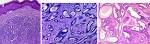eccrine <b>adenoma</b>).