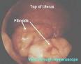 Hysteroscopy FAQ: diagnostic hysteroscopy, office hysteroscopy ...