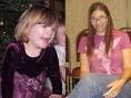 Cat Cry' Syndrome Often Undiagnosed - ABC News