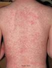 How is heat rash diagnosed and