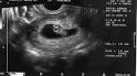 Miscarriage