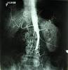 Aortoiliac occlusive disease