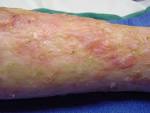 <b>Localized scleroderma</b> (LS)