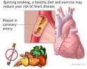 Coronary Heart Disease Prevention - Coronary Heart Disease Health ...