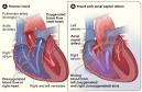 <b>Atrial Septal Defect</b> (ASD) | Congenital <b>Heart Defects</b> UK
